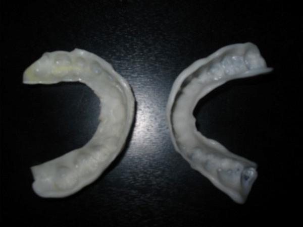 Orthodontic Retainer For Night Time